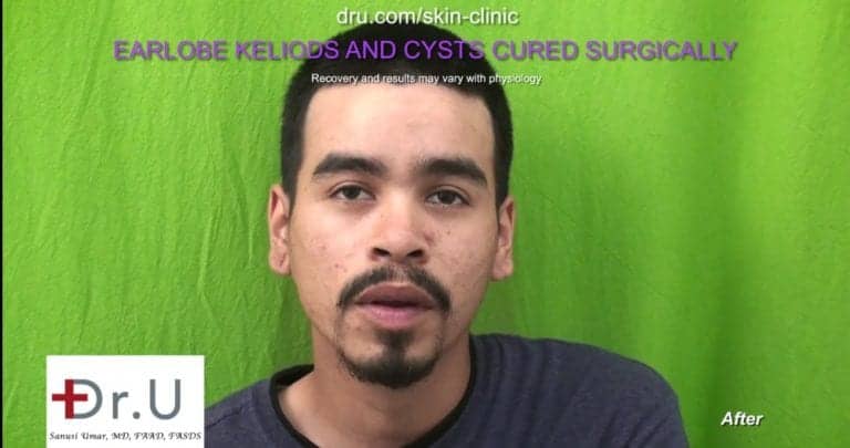 Patient's left and right ear appear similar to one another after Dr. U keloid cyst removal. Patient's left and right ear appear similar to one another after Dr. U keloid cyst removal