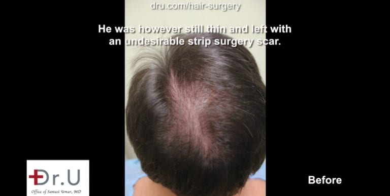 Patient not only hopes for a hair transplant with a natural hairline, but also coverage for the areas of failed growth Patient not only hopes for a hair transplant with a natural hairline, but also coverage for the areas of failed growth.