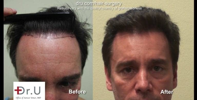A hair transplant with a natural hairline should have a soft outer edge. A hair transplant with a natural hairline should have a soft outer edge.