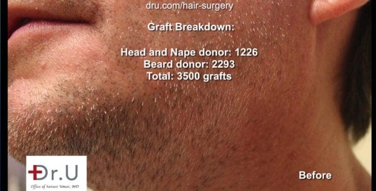 The Dr.UGraft™ undetectable hairline transplant and repair procedure required 3500 grafts. The Dr.UGraft™ undetectable hairline transplant and repair procedure required 3500 grafts.