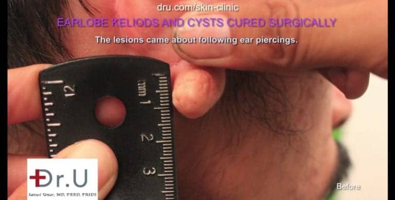Dr. U measures patient's keloid cyst prior to removing it through surgery. Dr. U measures patient's keloid cyst prior to removing it through surgery.