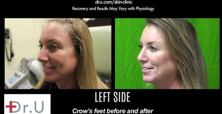 Left side of treatment results using Botox for crows feet around the eyes. Left side of treatment results using Botox for crows feet around the eyes.