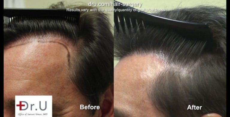 A Dr.UGraft™ undetectable hairline transplant focuses on intricate details for the temple region. A Dr.UGraft™ undetectable hairline transplant focuses on intricate details for the temple region.