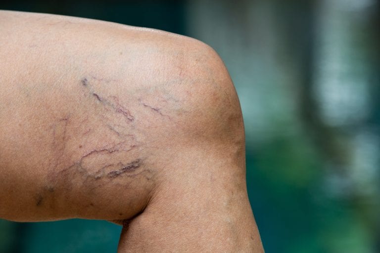 For spider veins on legs with are greater than 3 mm in width, laser removal may not be effective. For this reason, Dr. U recommends sclerotherapy for large varicose veins in the leg. For spider veins on legs with are greater than 3 mm in width, laser removal may not be effective. For this reason, Dr. U recommends sclerotherapy for large varicose veins in the leg.