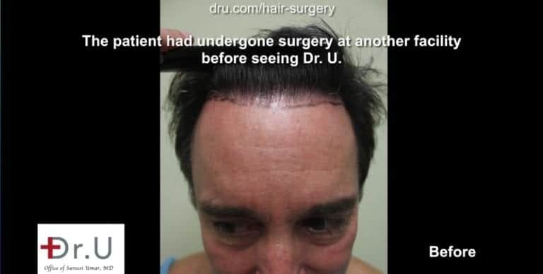 Torrance, Los Angeles patient before his Dr.UGraft™ undetectable hairline transplant. Torrance, Los Angeles patient before his Dr.UGraft™ undetectable hairline transplant.