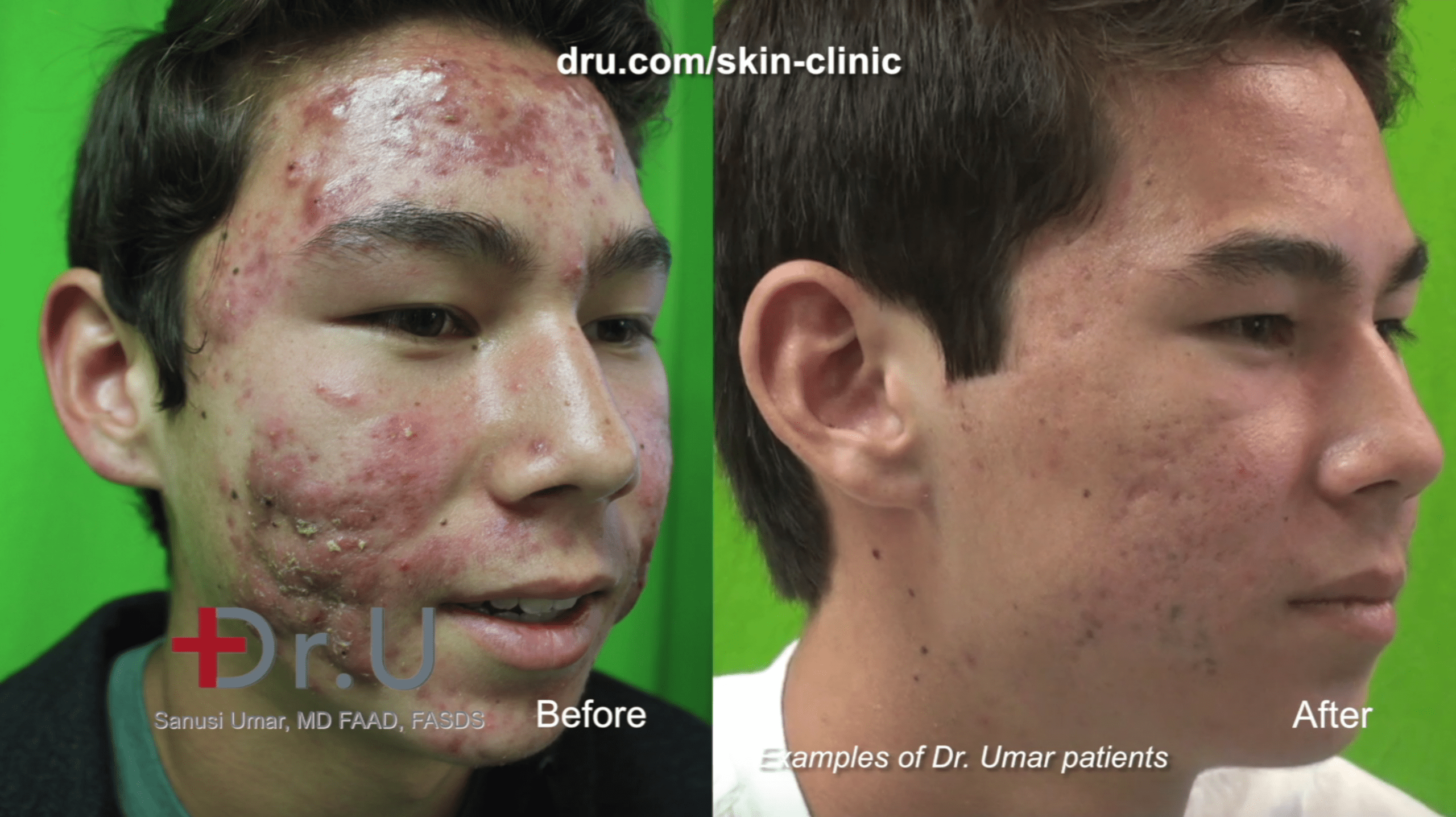The result of PDT laser treatment for acne at Dr. U Skin Clinic. The result of PDT laser treatment for acne at Dr. U Skin Clinic.*