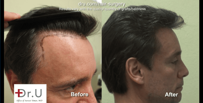 A hair transplant with a natural hairline must focus on the transition of the temples. A hair transplant with a natural hairline must focus on the transition of the temples.