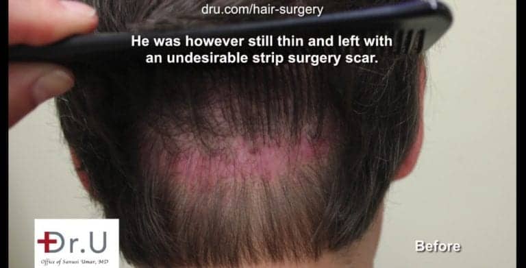 Many people ask, "does a hair transplant look natural" after a strip surgery with a large, obvious scar remaining Many people ask, "does a hair transplant look natural" after a strip surgery with a large, obvious scar remaining