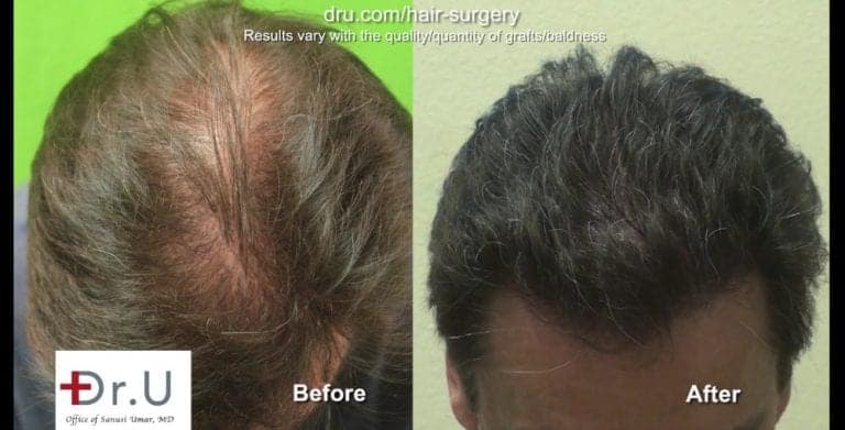 Does a hair transplant look natural? Dr.U's results show that the answer to this question is a resounding yes. Does a hair transplant look natural? Dr.U's results show that the answer to this question is a resounding yes.