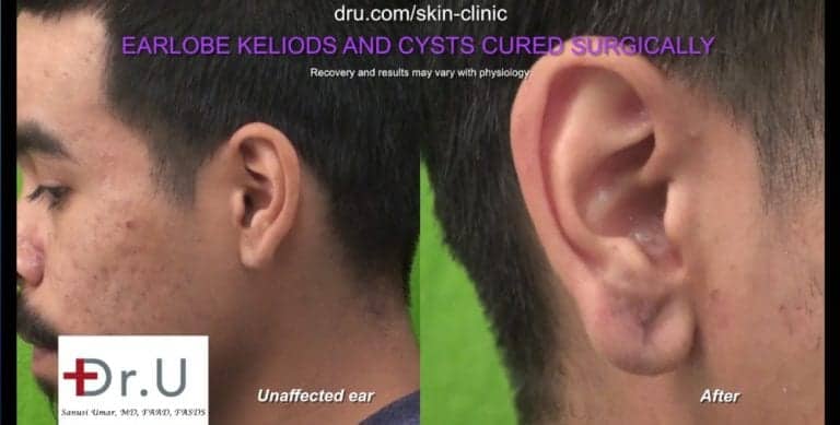 Comparison of earlobe affected by keloid cyst with the unaffected ear. Comparison of earlobe affected by keloid cyst with the unaffected ear.