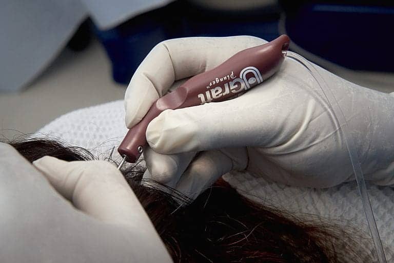 the Dr.UGraft™ Curl manual Punch at work on a patient. the Dr.UGraft™ Curl manual Punch at work on a patient.