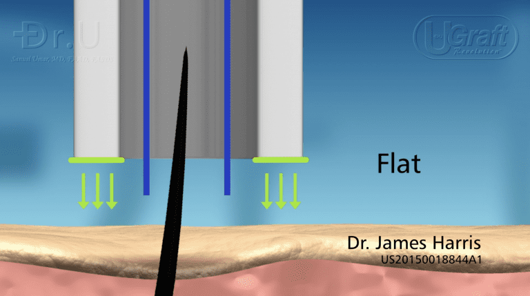 Blunt FUE punches with flat rims feature cutting surfaces perpendicular to the skin. Blunt FUE punches with flat rims feature cutting surfaces perpendicular to the skin.