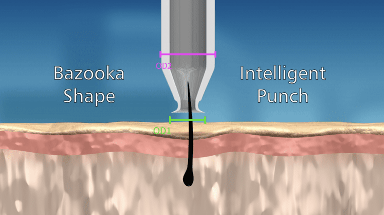 The bazooka shape of the roomed inner chamber allows for the collection of bulkier grafts without increasing wound size. The bazooka shape of the roomed inner chamber allows for the collection of bulkier grafts without increasing wound size.