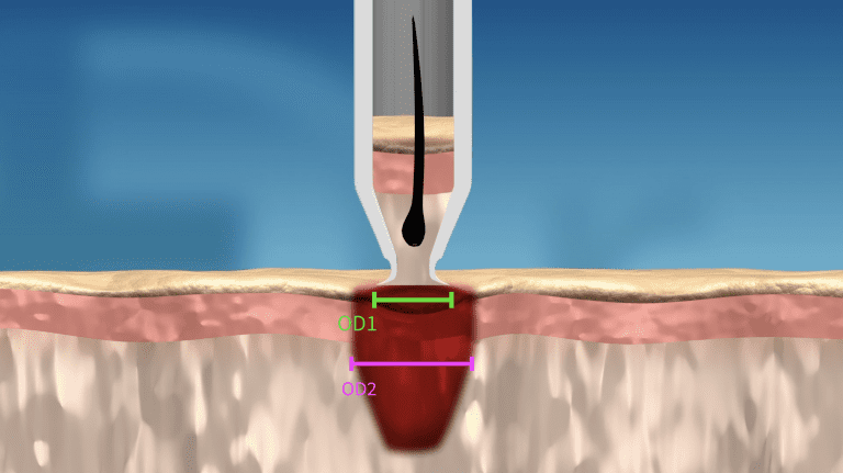 When the punch penetrates into the skin, the wound is gently stretched to the diameter of the lumen's widest point. When the punch penetrates into the skin, the wound is gently stretched to the diameter of the lumen's widest point.
