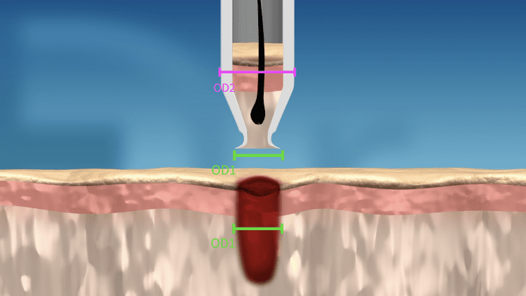 After the punch has been removed, the cavity of the wound left behind shrinks back to the original circumference of the smaller distal tip. After the punch has been removed, the cavity of the wound left behind shrinks back to the original circumference of the smaller distal tip.