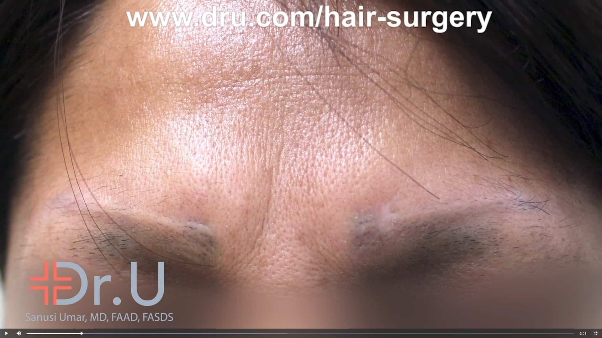 After a bad outcome from an eyebrow tattoo, she tried to have it removed by laser which caused eyebrow scarring. The result left her with a deformed eyebrow pattern formed by the scar and another formed by the tattoo outline. eyebrow tattoo laser