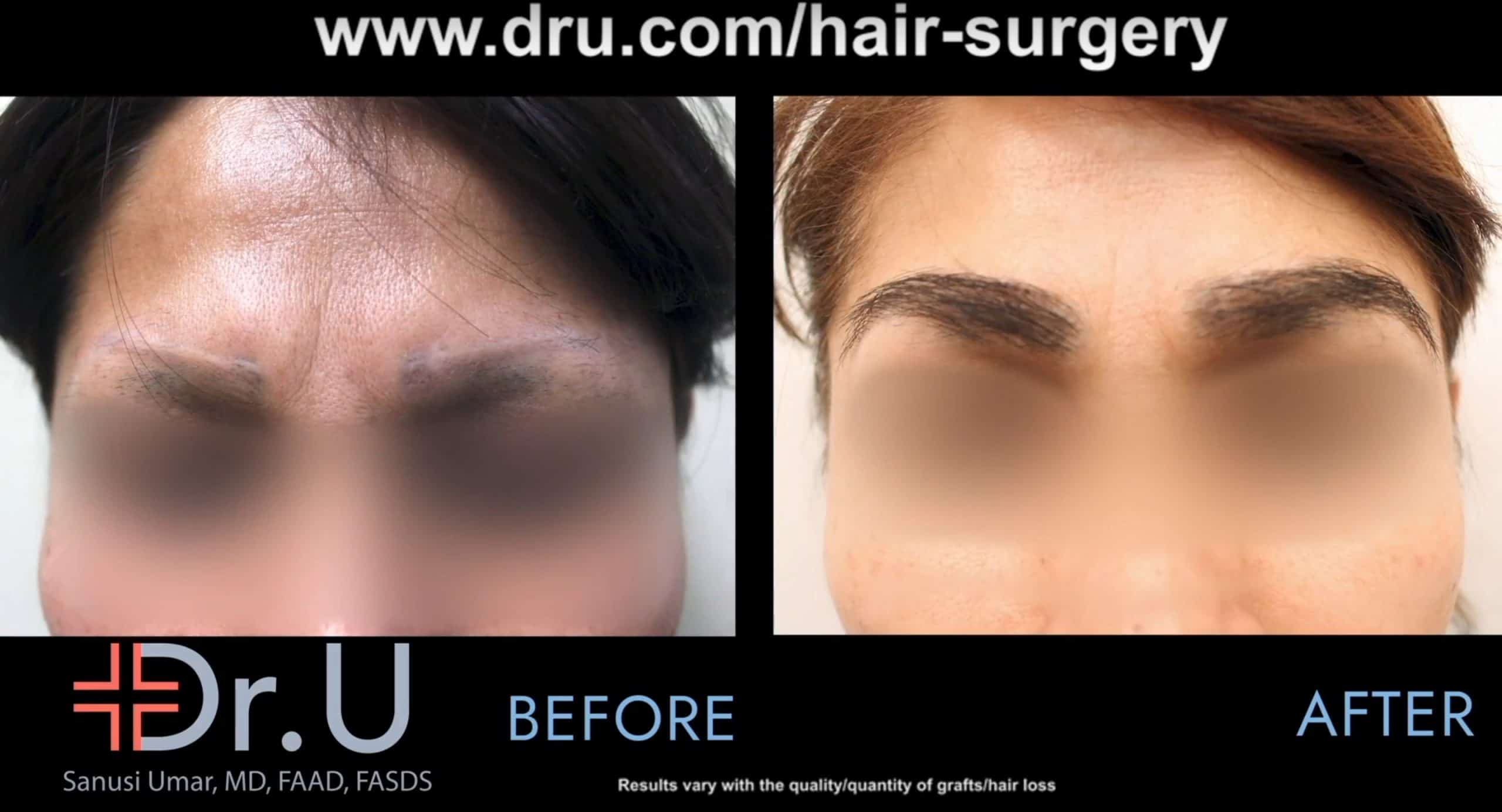 A Los Angeles patient before and after her eyebrow repair that corrected eyebrow discoloration and scarring. A Los Angeles patient before and after her eyebrow repair that corrected eyebrow discoloration and scarring.