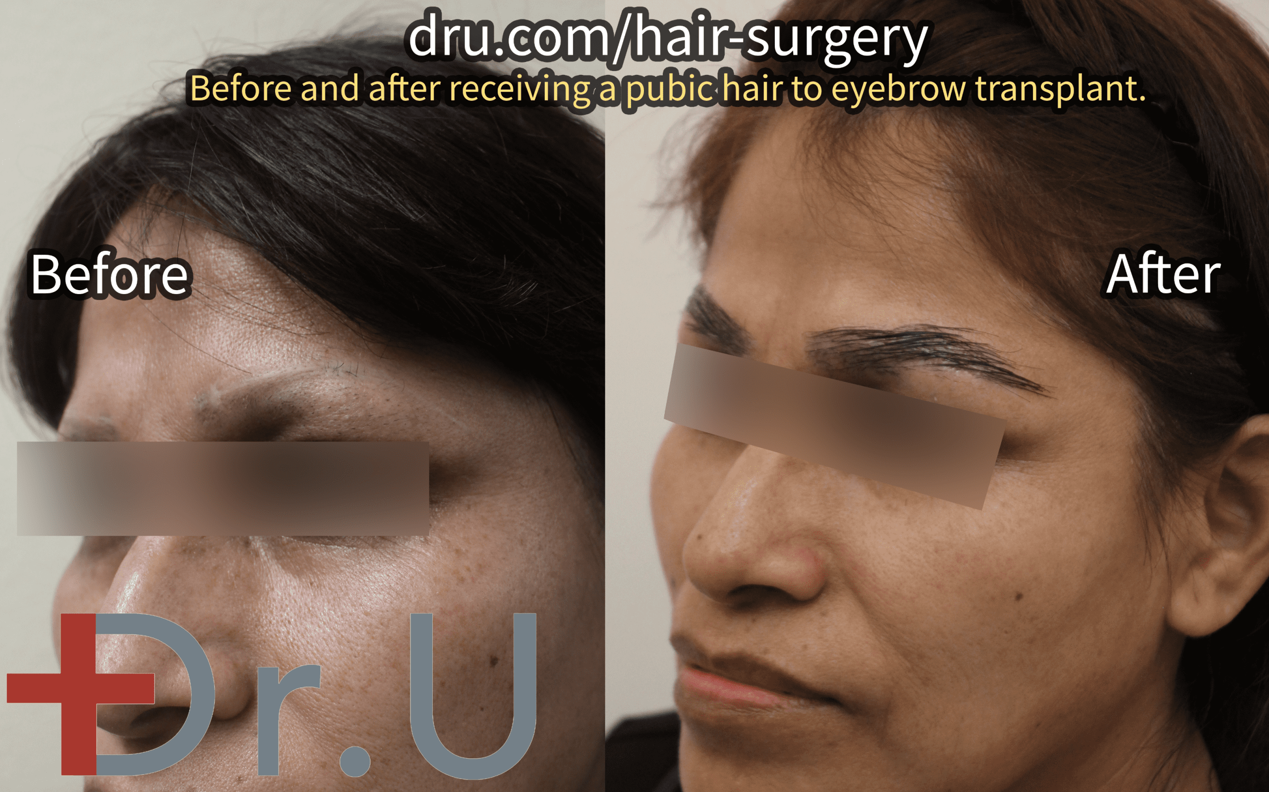 A Dr.UGraft™ eyebrow repair, before and after.* A Dr.UGraft™ eyebrow repair, before and after.*