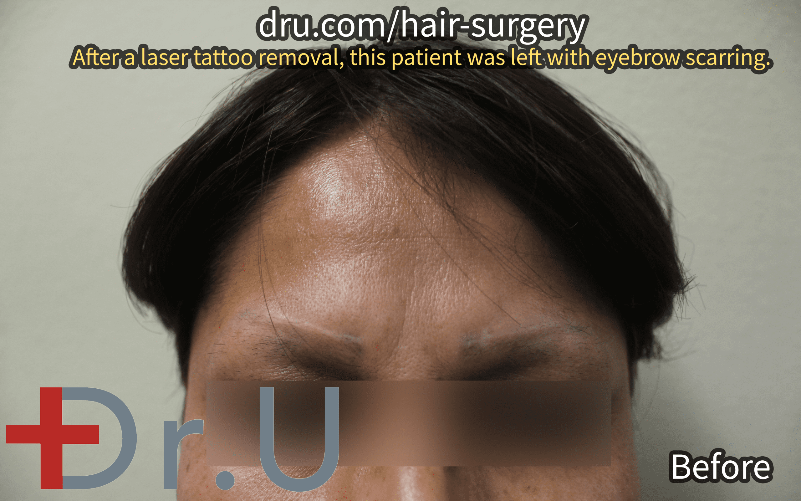 The California patient before her second eyebrow loss and tattoo scar repair surgery. She sought to diminish the appearance of her eyebrow scars. The California patient before her second eyebrow loss and tattoo scar repair surgery. She sought to diminish the appearance of her eyebrow scars.