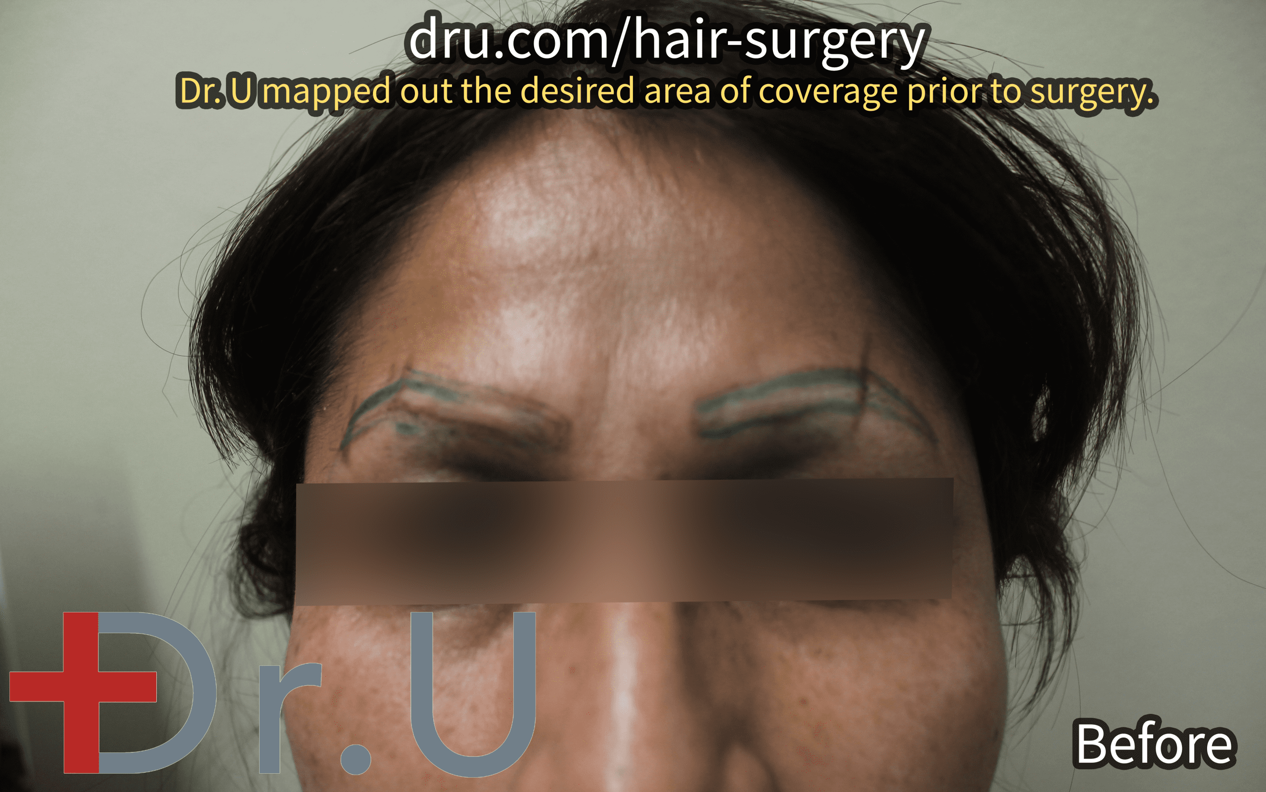 Dr. U mapped out the shape of the patient’s eyebrows as they grew prior to her laser tattoo removal. Dr. U mapped out the shape of the patient’s eyebrows as they grew prior to her laser tattoo removal.