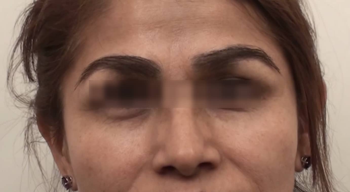 Los Angeles patient after eyebrow repair by Dr U which finally corrects her eyebrow discoloration and eyebrow scarring. Eyebrow repair