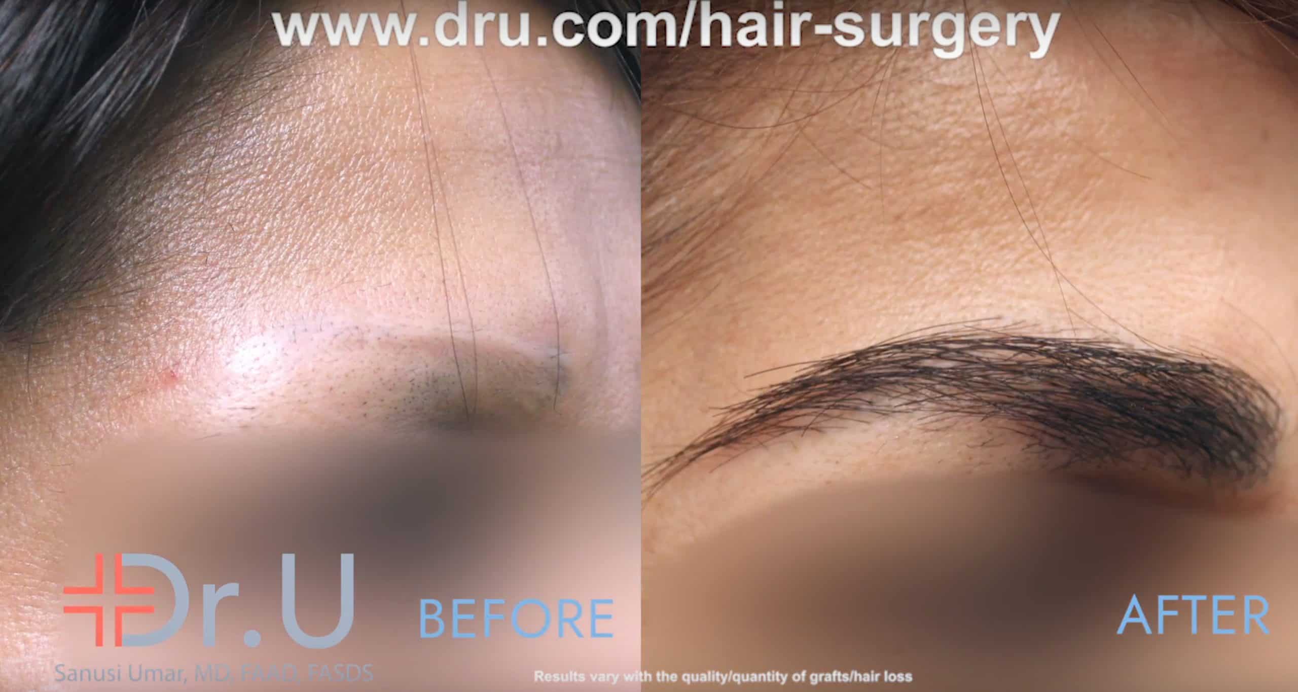 Though pubic hair may be an unusual choice for an FUE donor area in an eyebrow repair the patient's results have a real eyebrow texture with a natural look. Though pubic hair may be an unusual choice for an FUE donor area in an eyebrow repair the patient's results have a real eyebrow texture with a natural look.
