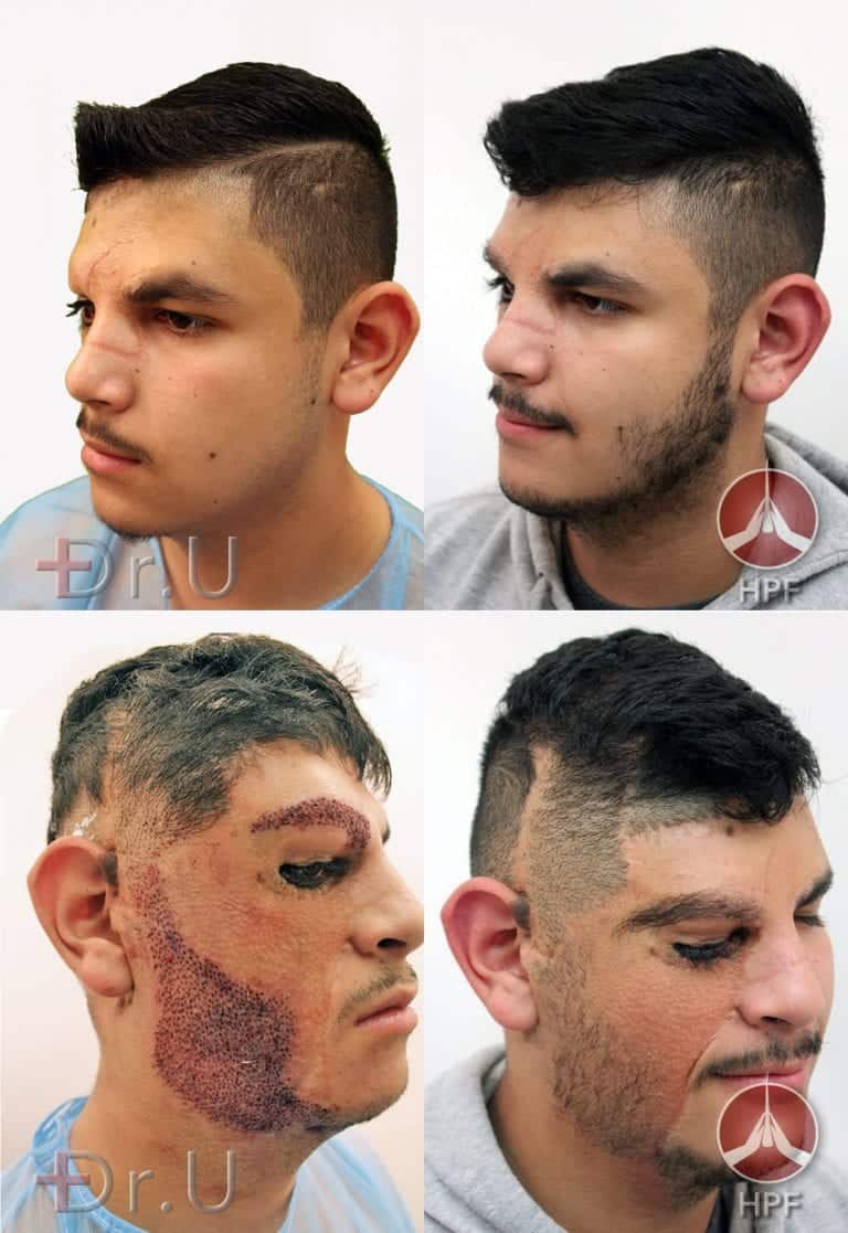 Top row shows the sideburn hair transplant results on the left side of patient's face. Bottom row shows how Dr.U replicated these contours on the right side Top row shows the sideburn hair transplant results on the left side of patient's face. Bottom row shows how Dr.U replicated these contours on the right side