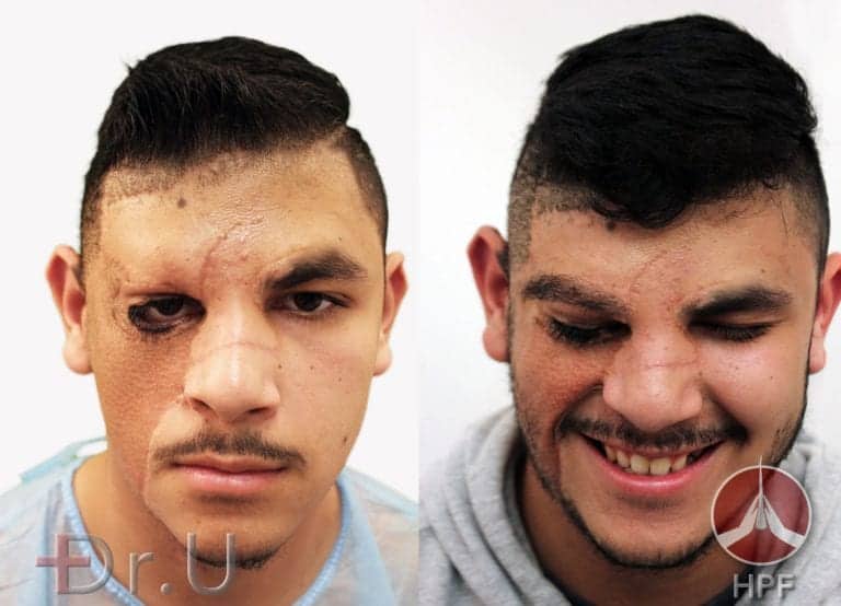 Eyebrow and beard transplant patient before and after his Dr.UGraft procedure using nape and leg hair grafts Eyebrow and beard transplant patient before and after his Dr.UGraft procedure using nape and leg hair grafts