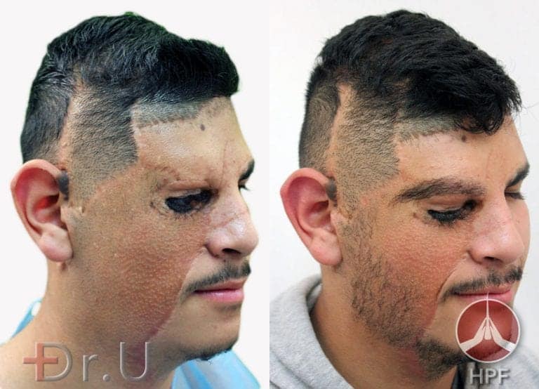 Before and after photos of Dr.U's sideburn hair transplant on right side of patient's face Before and after photos of Dr.U's sideburn hair transplant on right side of patient's face