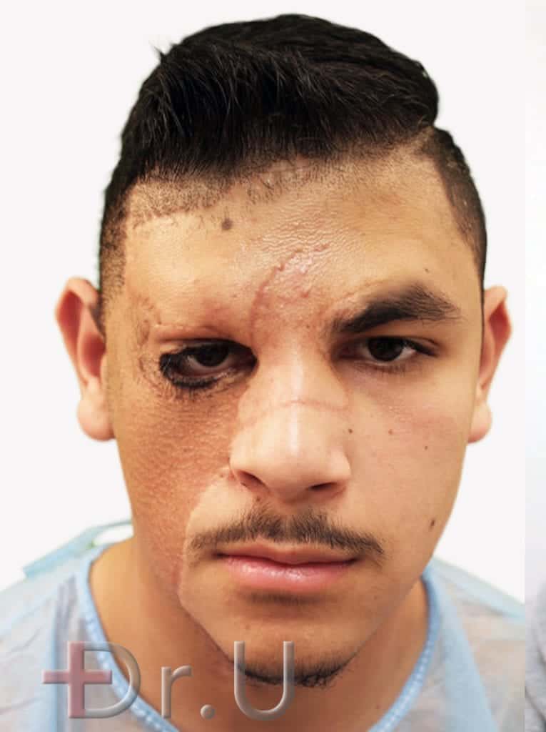 Patient shown with missing left eyebrow due to the placement of a skin graft on his forehead Patient shown with missing left eyebrow due to the placement of a skin graft on his forehead