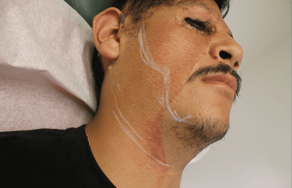 Dr.U plans out the area where grafts will be inserted for the patient's beard and sideburn hair transplant Dr.U plans out the area where grafts will be inserted for the patient's beard and sideburn hair transplant