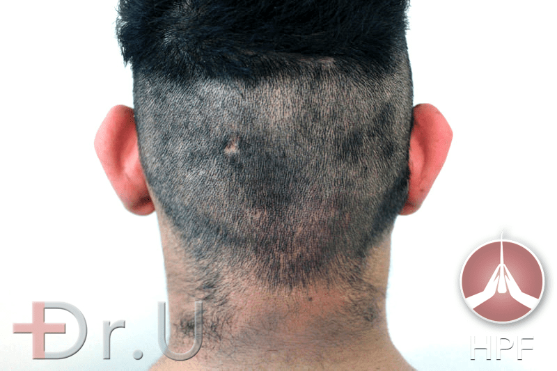 Dr.U's FUE Shave Test results show an even distribution of hair throughout the scalp. This patient, therefore, qualified for the long-term use of nape hair for his eyebrow and beard transplant procedure Dr.U's FUE Shave Test results show an even distribution of hair throughout the scalp. This patient, therefore, qualified for the long-term use of nape hair for his eyebrow and beard transplant procedure