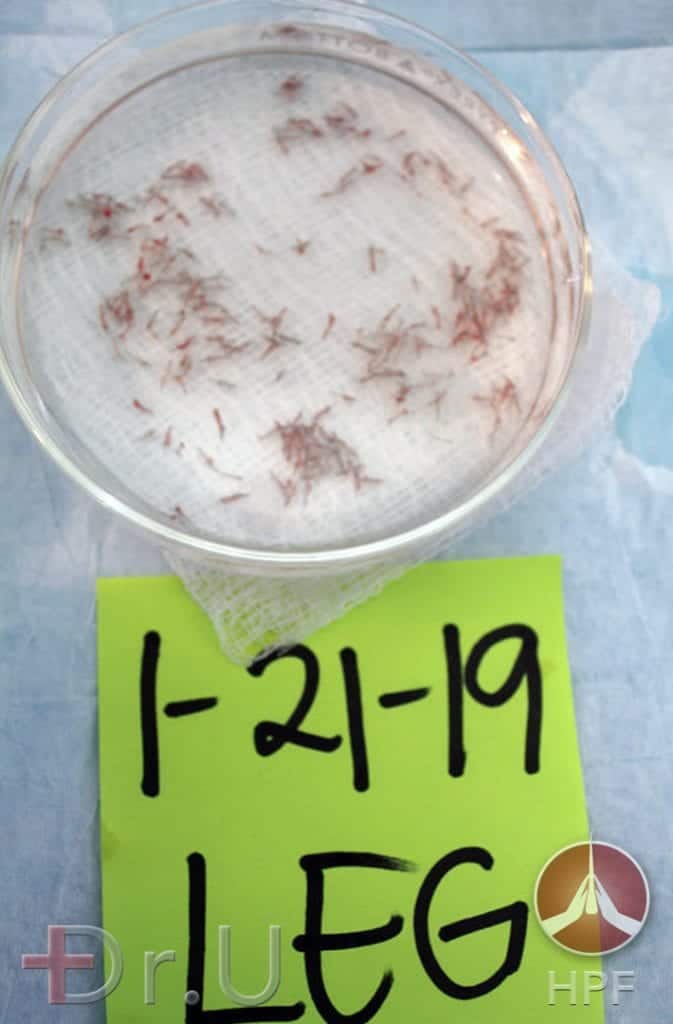 Photo of leg hair grafts safely extracted with the Dr.UGraft Intuitive FUE system. These were used for this patient's eyebrow reconstruction surgery and facial hair transplantation Photo of leg hair grafts safely extracted with the Dr.UGraft Intuitive FUE system. These were used for this patient's eyebrow reconstruction surgery and facial hair transplantation