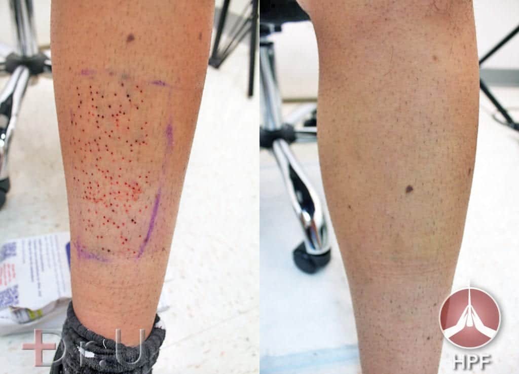 Before and after photos show excellent healing of patient's leg which helped supply donor grafts for this eyebrow and beard transplant procedure Before and after photos show excellent healing of patient's leg which helped supply donor grafts for this eyebrow and beard transplant procedure