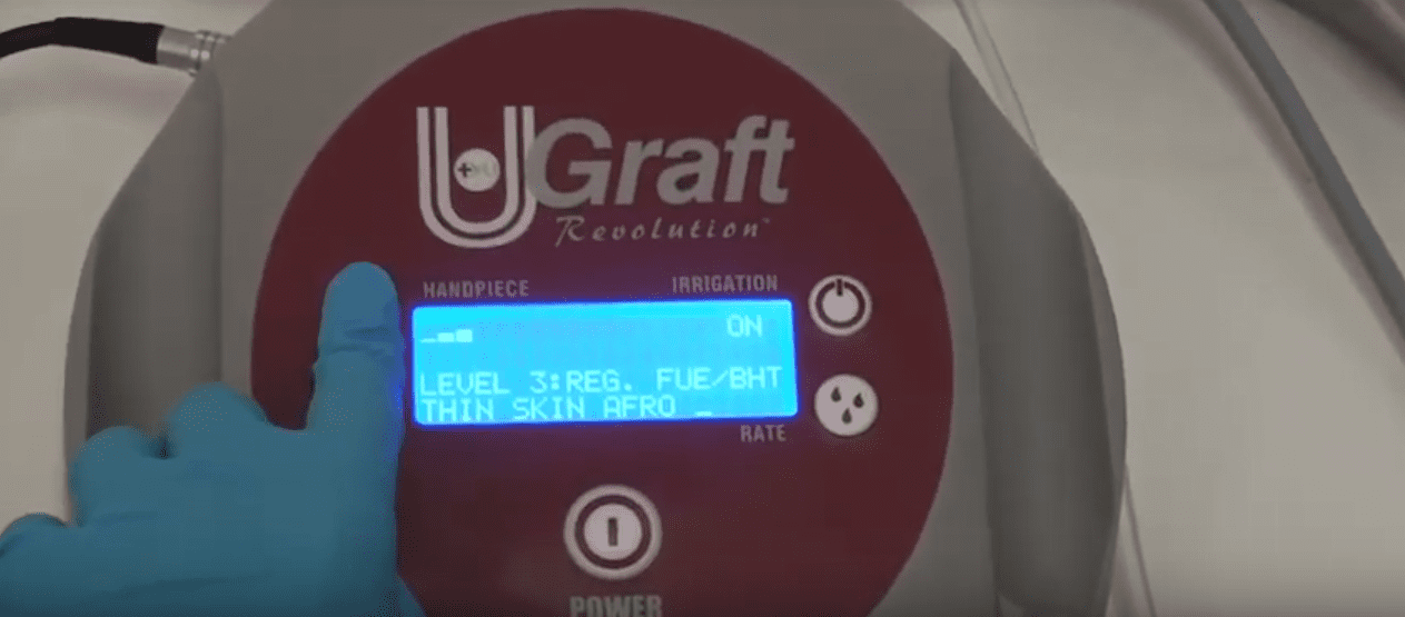 The Dr.UGraft Intuitive FUE technology offers the ability to customize both the speed and the torque of the punch's rotation to best suit the skin thickness of individual patients. The Dr.UGraft Intuitive FUE technology offers the ability to customize both the speed and the torque of the punch's rotation to best suit the skin thickness of individual patients.