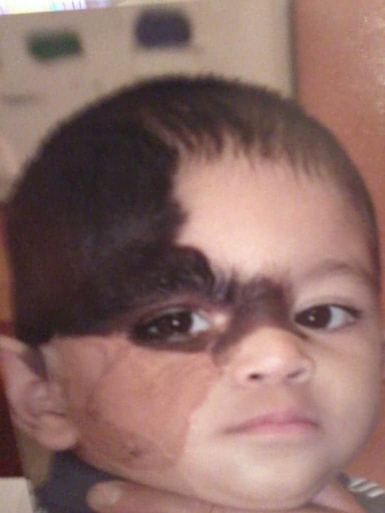 Los Angeles patient was born with a congenital nevus, undergoing several plastic surgeries to remove sections of the darkened skin. Los Angeles patient was born with a congenital nevus, undergoing several plastic surgeries to remove sections of the darkened skin.