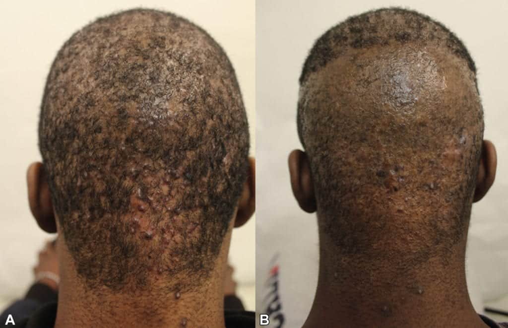 Dr.U’s Selective Treatment Approach For Acne Keloidalis Nuchae Laser Treatment Dr. Umar Hair