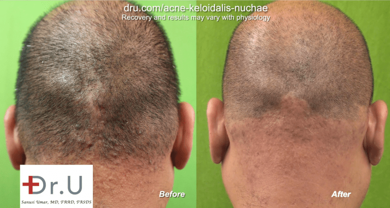 Dr.U's laser approach to treating Acne Keloidalis Nuchae involves the targeting of all the hair follicles within a defined treatment zone. Dr.U's laser approach to treating Acne Keloidalis Nuchae involves the targeting of all the hair follicles within a defined treatment zone.
