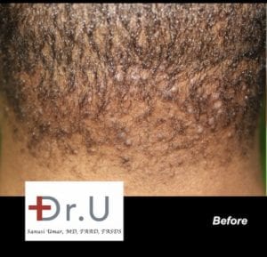 Acne Keloidalis Nuchae bumps in their initial stage