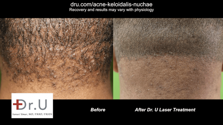 patient before and after laser treatment for early stage Acne Keloidalis Nuchae patient before and after laser treatment for early stage Acne Keloidalis Nuchae
