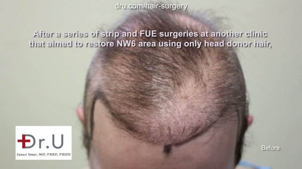 Pre Strip Surgery Hair Transplant Repair Repairing donor hair depleted patient using DrUGraft: patient prior to body hair for restoring donor depleted bald patient