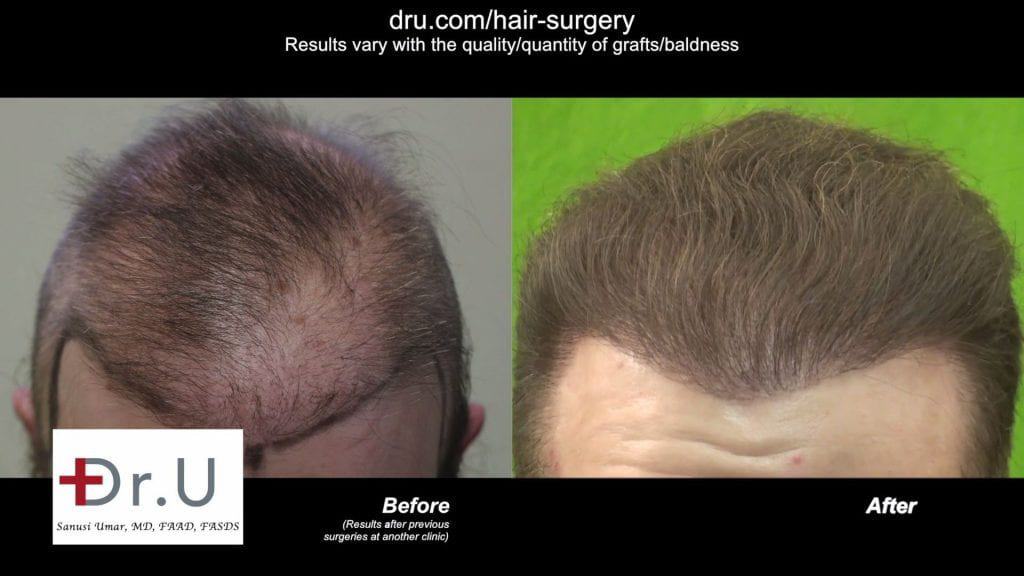 After failed transplants elsewhere. This patient got a repair by Dr U Using beard and body hair