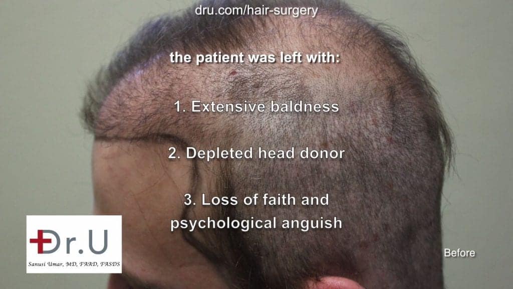 Repairing donor hair depleted patient using DrGraft Los Angeles: hair transplant not enough donor hair Repairing donor hair depleted patient using DrGraft Los Angeles: hair transplant not enough donor hair