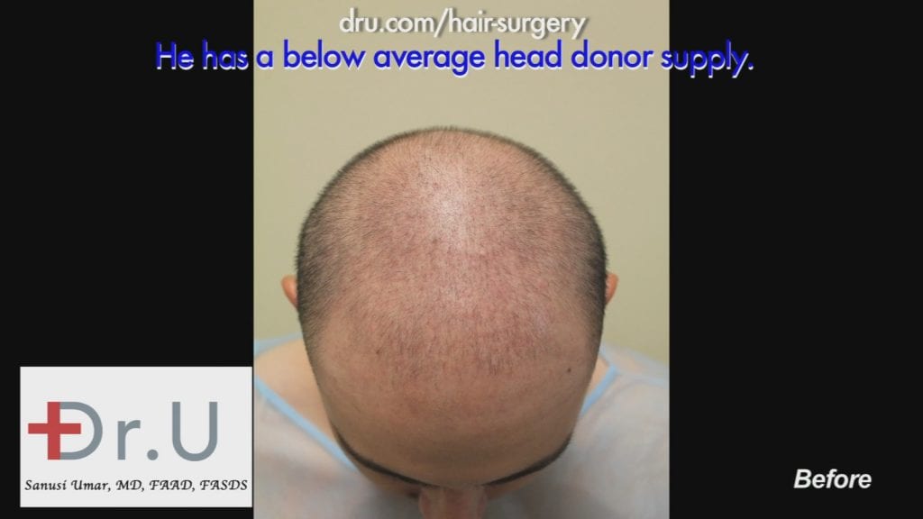 Before Hair Restoration: Severe hair loss at young age Before Hair Restoration: Severe hair loss at young age