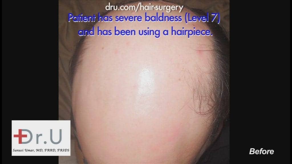 10500 Dr.UGrafts are used to cure patient's Norwood 7 baldness 10500 Dr.UGrafts are used to cure patient's Norwood 7 baldness