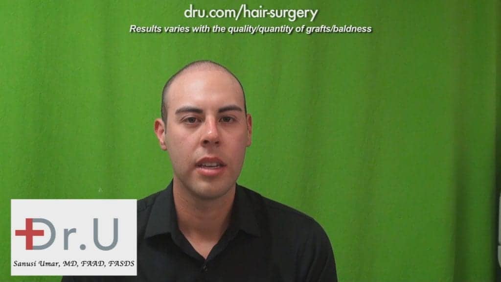 Hair transplant age 23: One year after Hair Restoration using 2000 Dr.UGrafts Hair transplant age 23: One year after Hair Restoration using 2000 Dr.UGrafts