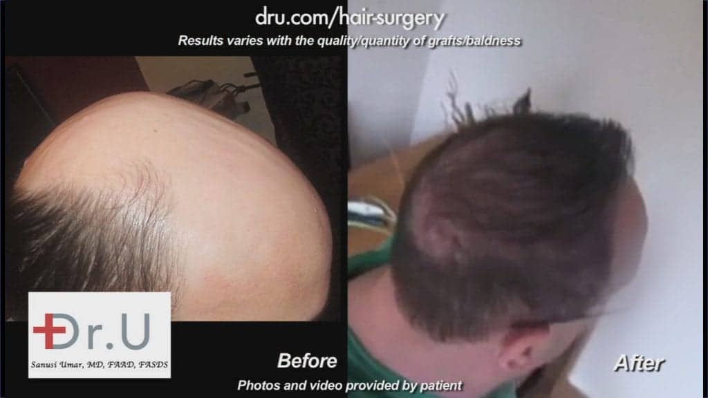 This severely bald patient experienced the Dr.UGraft™ advantage first-hand with an extraordinary outcome.* This severely bald patient experienced the Dr.UGraft™ advantage first-hand with an extraordinary outcome.*