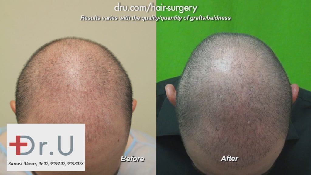 Hair transplant age 23: Hair Restoration Before and After using 2000 Dr.UGrafts Hair transplant age 23: Hair Restoration Before and After using 2000 Dr.UGrafts