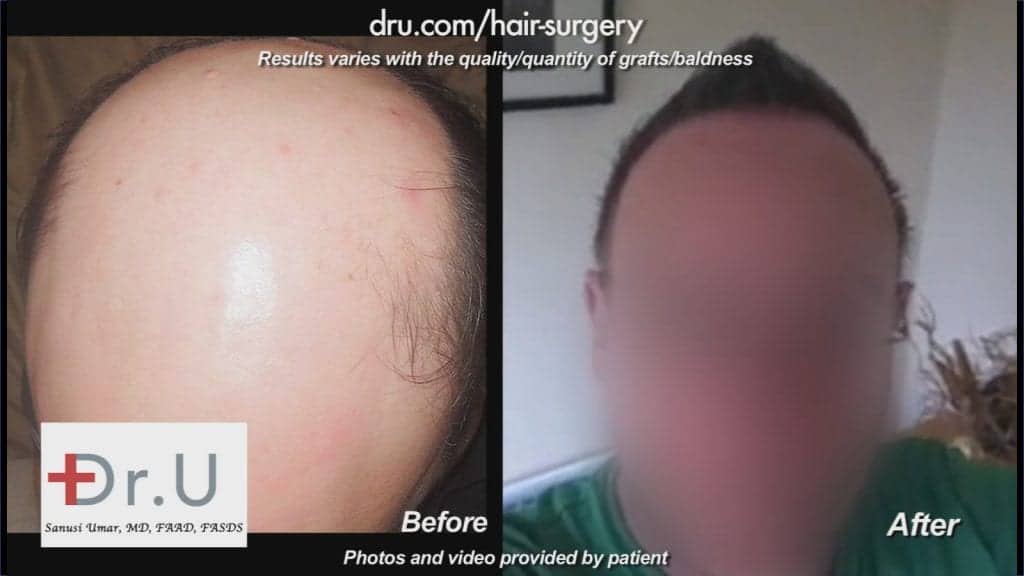 Norwood 7 hair transplant hairline before and after using 10500 Dr.UGrfts Norwood 7 hair transplant hairline before and after using 10500 Dr.UGrfts
