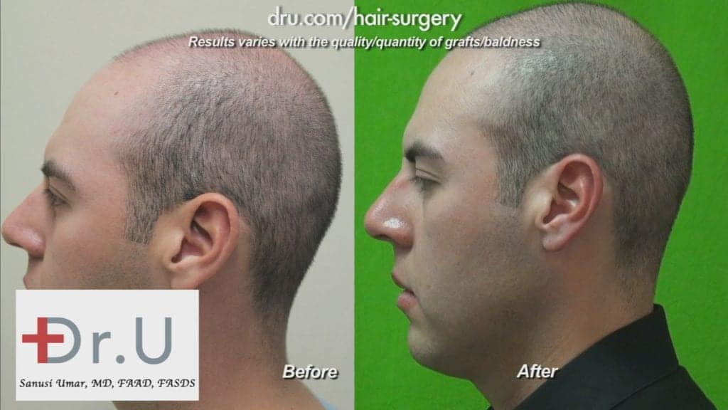 How young is too young for hair restoration: Young Hair Restoration Before and After How young is too young for hair restoration: Young Hair Restoration Before and After